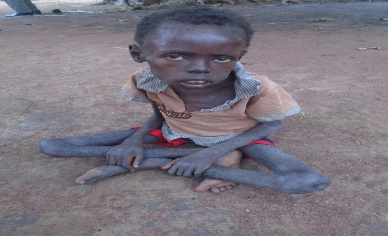 Photos of the most severe malnourished children